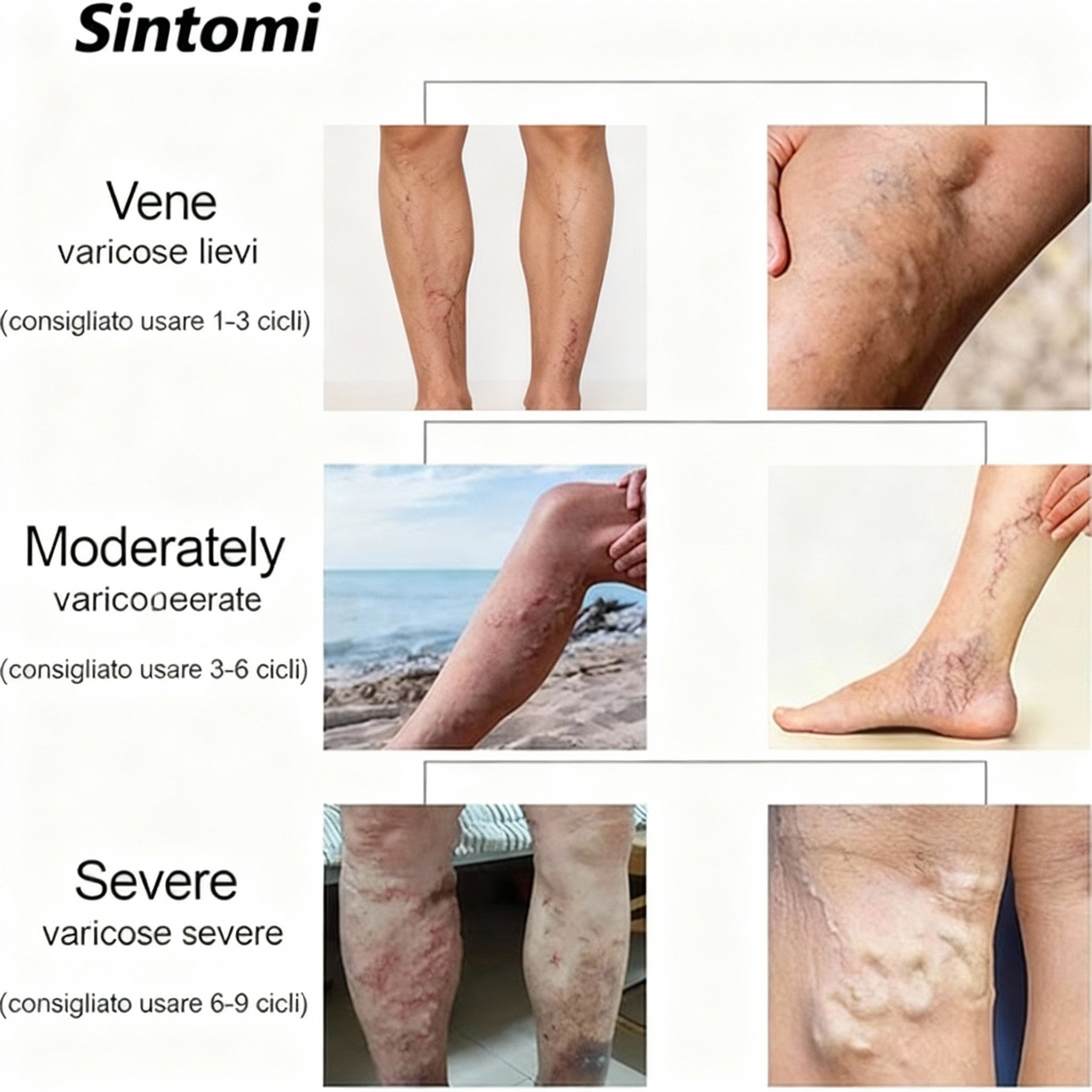2 x VeinCare Gel Moderato, Crema per Vene Varicose, Trattamento per le Vene Varicose delle Gambe, Gel Lenitivo per Vene Varicose, Migliora la Circolazione Sanguigna e Allevia il Gonfiore.