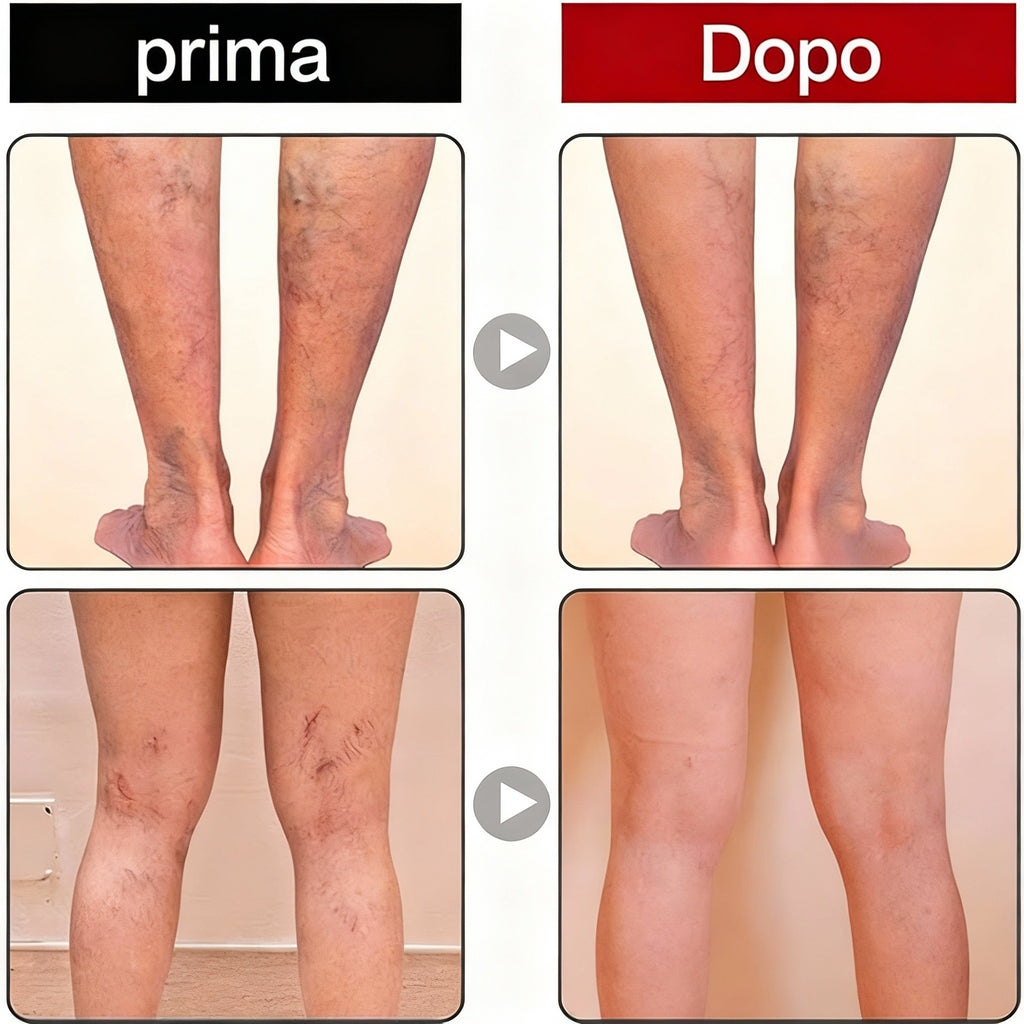 2 x VeinCare Gel Moderato, Crema per Vene Varicose, Trattamento per le Vene Varicose delle Gambe, Gel Lenitivo per Vene Varicose, Migliora la Circolazione Sanguigna e Allevia il Gonfiore.
