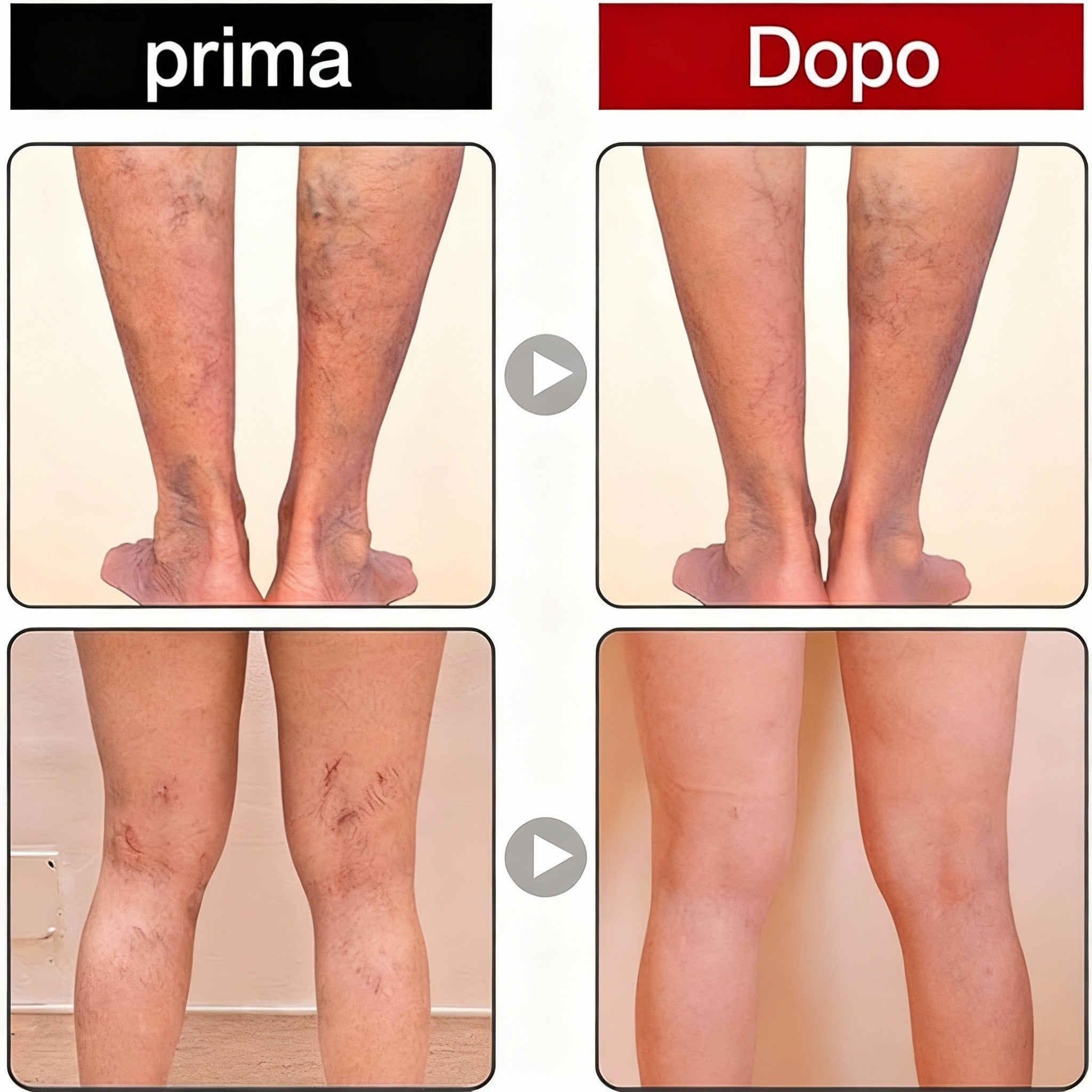2 x VeinCare Gel Moderato, Crema per Vene Varicose, Trattamento per le Vene Varicose delle Gambe, Gel Lenitivo per Vene Varicose, Migliora la Circolazione Sanguigna e Allevia il Gonfiore.